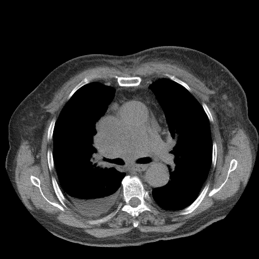 Bronchogenic carcinoma with metastatic lymphadenopathy (Radiopaedia 37671-39569 Axial non-contrast 24).jpg