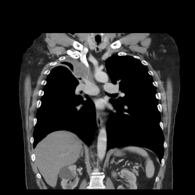 Bronchogenic carcinoma with upper lobe collapse (Radiopaedia 29297-29726 D 32).jpg