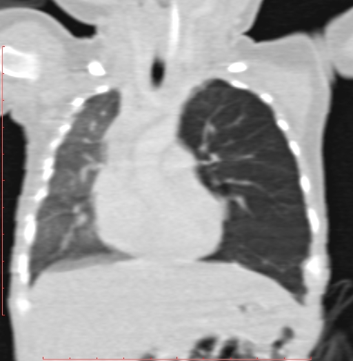 File:Bronchogenic cyst (Radiopaedia 78599-91409 Coronal lung window 100).jpg