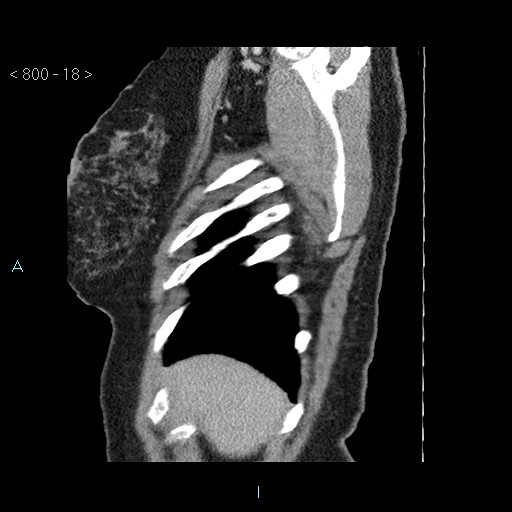Bronchogenic cyst - posterior mediastinal (Radiopaedia 43885-47364 B 11).jpg