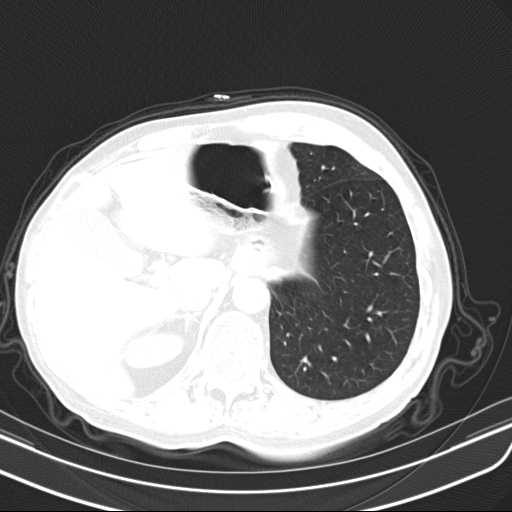 Bronchopleural fistula - postoperative complication (Radiopaedia 21020-20947 Axial lung window 50).jpg
