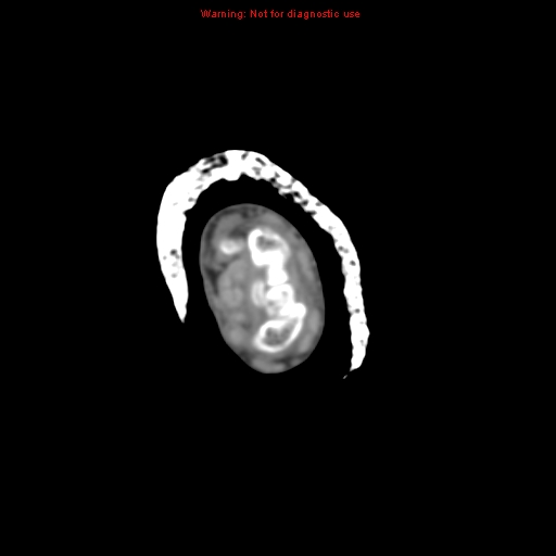 Brown tumor (Radiopaedia 12460-12694 Axial non-contrast 11).jpg