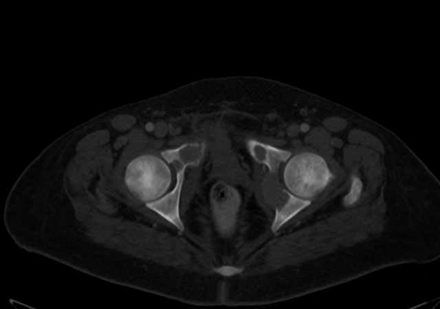 Brown tumors compressing the spinal cord (Radiopaedia 68442-77988 G 122).jpg