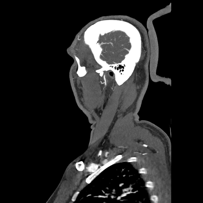 Buccal fat pad arteriovenous malformation (Radiopaedia 70936-81144 C 66).jpg