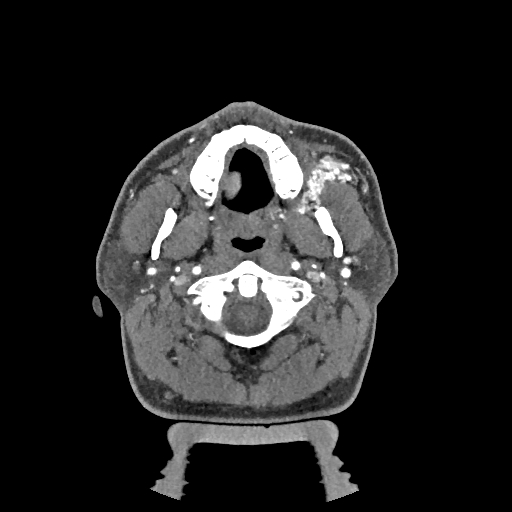 Buccal fat pad arteriovenous malformation (Radiopaedia 70936-81144 D 209).jpg