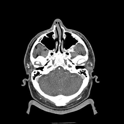 Buccal fat pad arteriovenous malformation (Radiopaedia 70936-81144 D 251).jpg