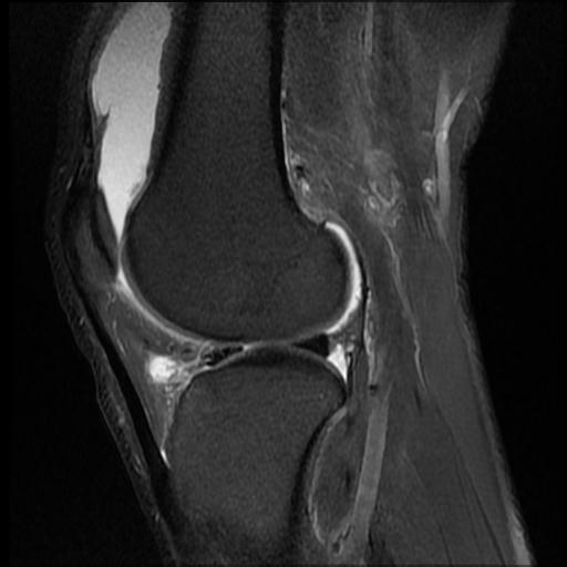 File:Bucket handle tear - medial meniscus (Radiopaedia 69245-79026 Sagittal PD fat sat 6).jpg