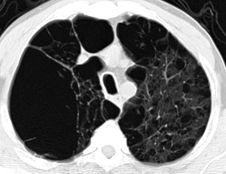 File:Bullous emphysema (Radiopaedia 15948-15606 Axial lung window 1).jpg
