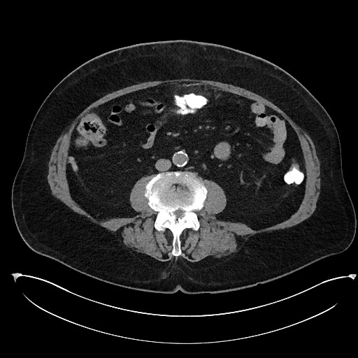 Buried bumper syndrome - gastrostomy tube (Radiopaedia 63843-72577 Axial Inject 63).jpg