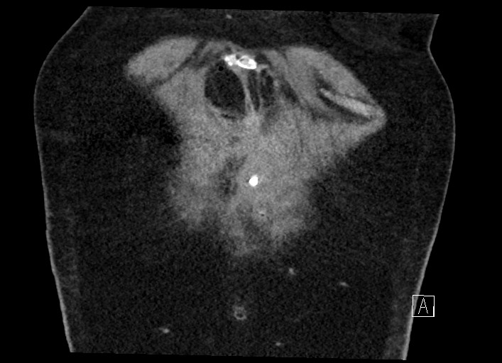 File:Buried bumper syndrome - gastrostomy tube (Radiopaedia 63843-72577 Coronal Inject 17).jpg