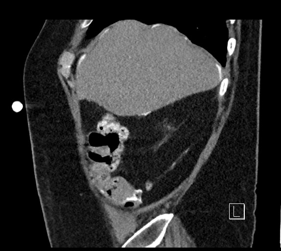 Buried bumper syndrome - gastrostomy tube (Radiopaedia 63843-72577 Sagittal Inject 101).jpg