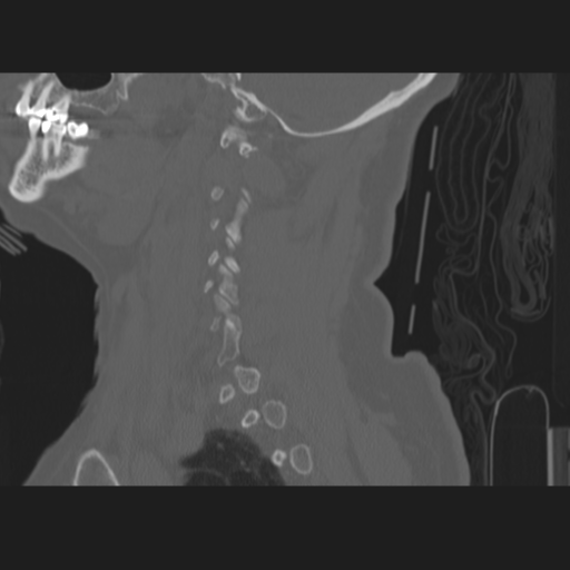C2 fracture (Radiopaedia 34091-35341 Sagittal bone window 54).png
