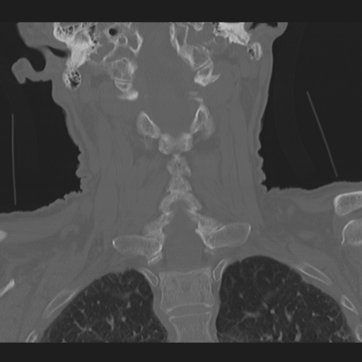 File:C2 fracture with vertebral artery dissection (Radiopaedia 37378-39199 Axial bone window 1).png