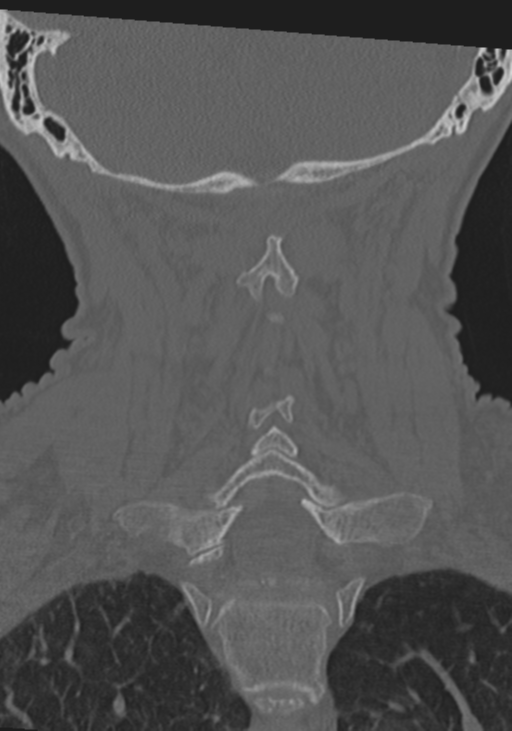 C2 fracture with vertebral artery dissection (Radiopaedia 37378-39199 Coronal bone window 36).png