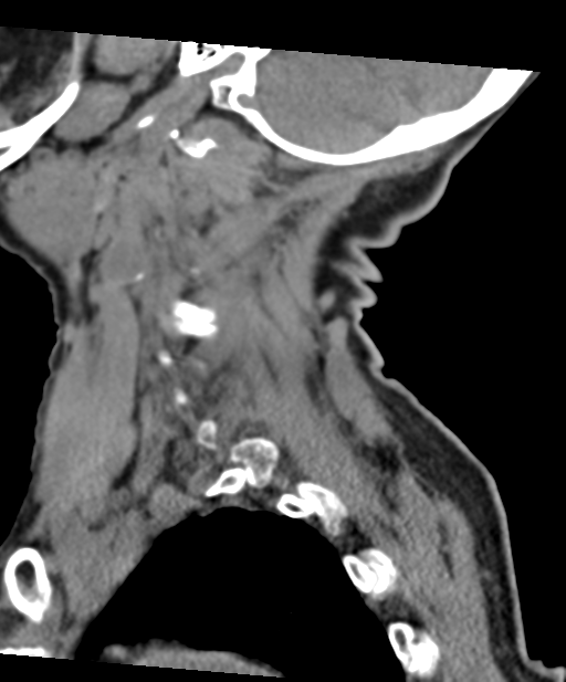 C2 fracture with vertebral artery dissection (Radiopaedia 37378-39199 D 19).png