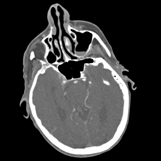 File:C2 fracture with vertebral artery dissection (Radiopaedia 37378-39200 A 226).png