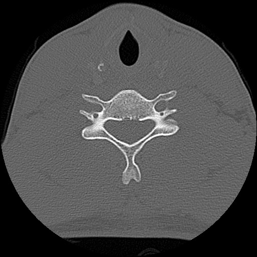 File:C5 facet fracture (Radiopaedia 58374-65499 Axial bone window 62).jpg