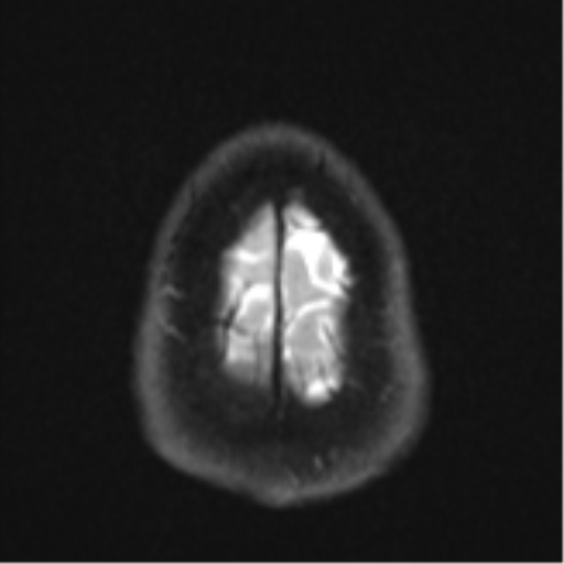 File:CNS vasculitis (Radiopaedia 55715-62263 Axial DWI 28).png