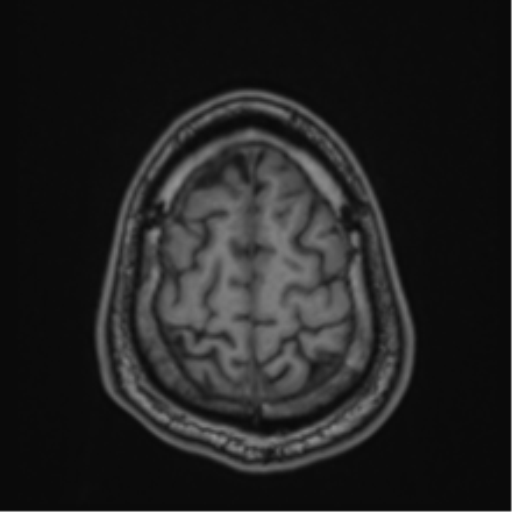 CNS vasculitis (Radiopaedia 55715-62263 Axial T1 89).png