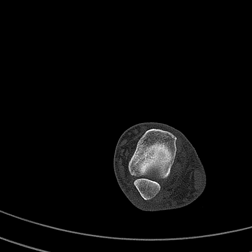 File:Calcaneal fracture - Sanders type 4 (Radiopaedia 90179-107370 Axial bone window 20).jpg
