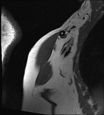 File:Calcific tendinitis of the infraspinatus tendon (Radiopaedia 87256-103537 Coronal T1 1).jpg