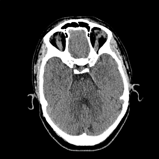File:Calcified cerebral hydatid cyst (Radiopaedia 65603-74717 Axial non-contrast 18).jpg