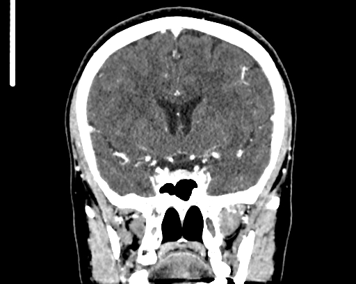 Calcified cerebral hydatid cyst (Radiopaedia 65603-74717 C 28).jpg