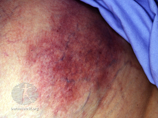 File:Calciphylaxis can lead to- (DermNet NZ systemic-calciphylaxis1).jpg