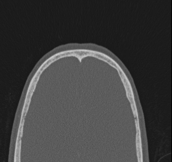 Caldwell-Luc operation (Radiopaedia 52329-58225 Axial bone window 4).jpg