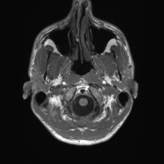 Callosal dysgenesis with interhemispheric cyst (Radiopaedia 53355-59335 Axial T1 9).jpg