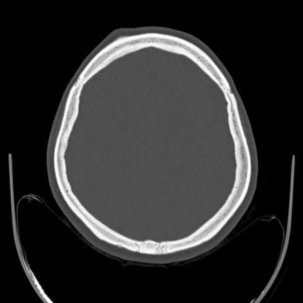 Calvarial osteoma (Radiopaedia 36520-38079 Axial bone window 77).jpg
