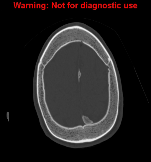 Calvarial thickening from chronic shunting (Radiopaedia 60079-67637 Axial bone window 151).jpg