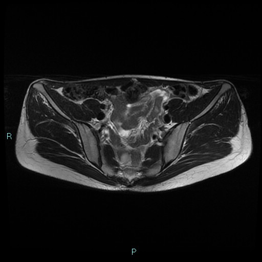 File:Canal of Nuck cyst (Radiopaedia 55074-61448 Axial T2 3).jpg