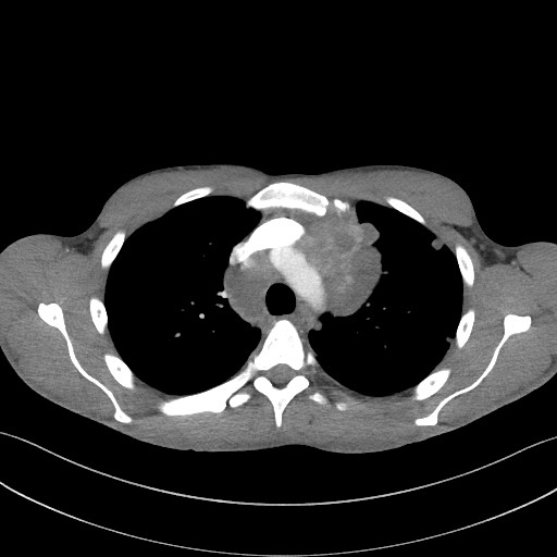 Cannonball metastases - testicular choriocarcinoma (Radiopaedia 84510-99891 B 40).jpg