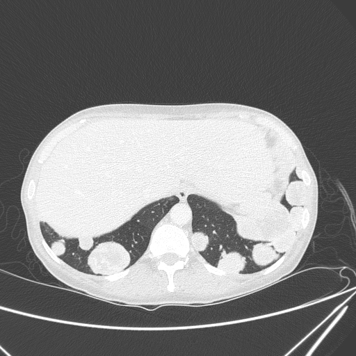 Canonball lung metastasis (Radiopaedia 77634-89837 Axial lung window 158).jpg