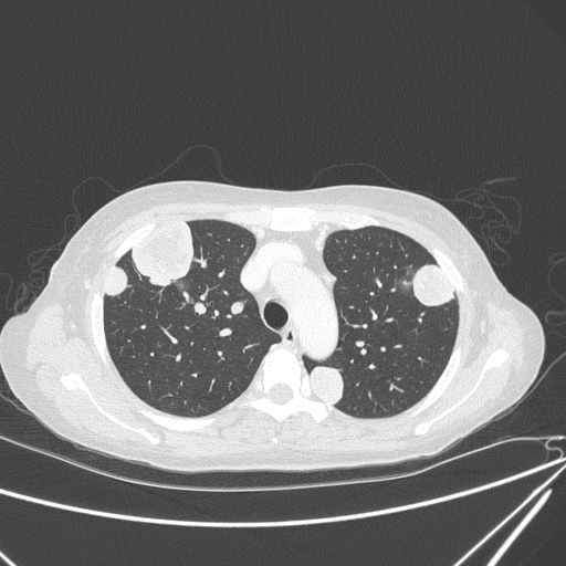 Canonball lung metastasis (Radiopaedia 77634-89837 Axial lung window 51).jpg