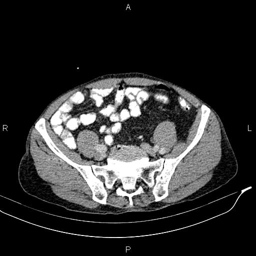 Caput medusae sign - portal hypertension (Radiopaedia 64007-72759 A 74).jpg