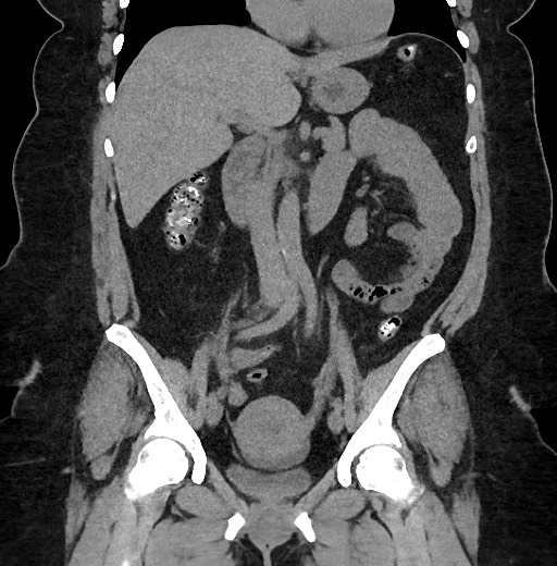 Carcinoid tumor - terminal ileum (Radiopaedia 60931-68740 Coronal non-contrast 49).jpg
