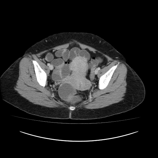 File:Carcinoma colon - hepatic flexure (Radiopaedia 19461-19493 A 113).jpg
