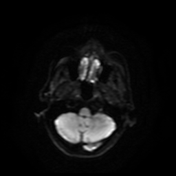 Carcinoma ex-pleomorphic adenoma of parotid (Radiopaedia 28383-28627 Ax DWI B-500 GE 60).jpg