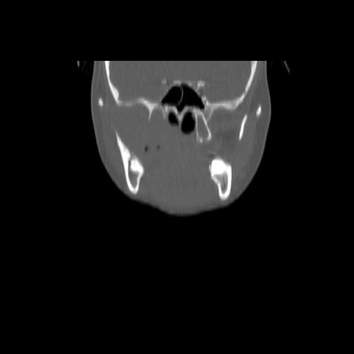 Carcinoma of the maxillary antrum (Radiopaedia 53805-59888 Coronal bone window 59).jpg
