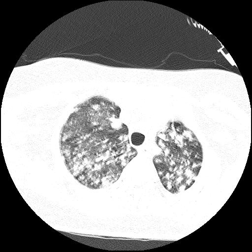 Cardiac angiosarcoma (Radiopaedia 66010-75181 Axial lung window 76).jpg