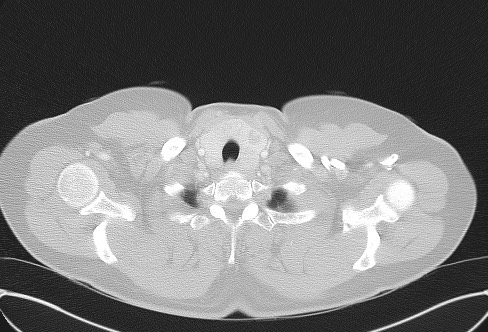File:Cardiac sarcoidosis (Radiopaedia 74548-85534 Axial lung window 4).jpg