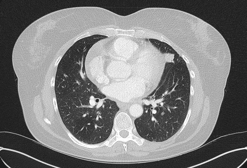 File:Cardiac sarcoidosis (Radiopaedia 74548-85534 Axial lung window 48).jpg