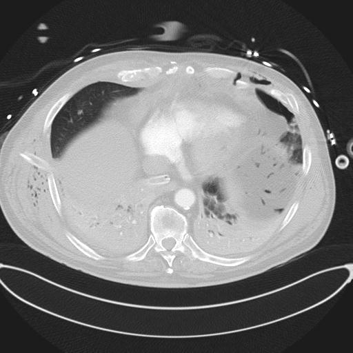 Cardiac trauma (Radiopaedia 32874-33858 Axial lung window 41).jpg