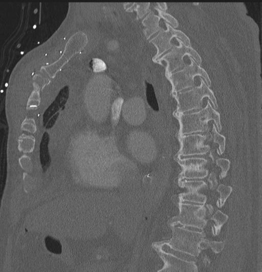 Cardiac trauma (Radiopaedia 32874-33858 Sagittal bone window 51).jpg