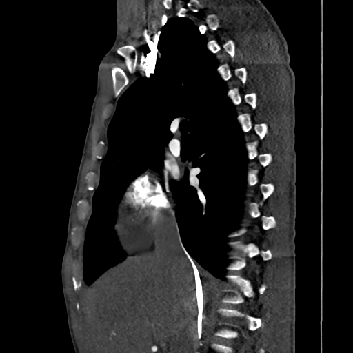 Cardiac tumor - undifferentiated pleomorphic sarcoma (Radiopaedia 45844-50134 B 49).png