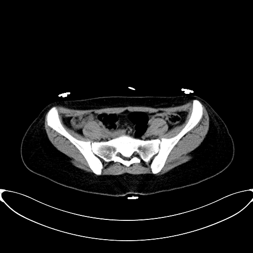 File:Caroli disease with medullary sponge kidney (Radiopaedia 82622-96804 Axial non-contrast 57).jpg