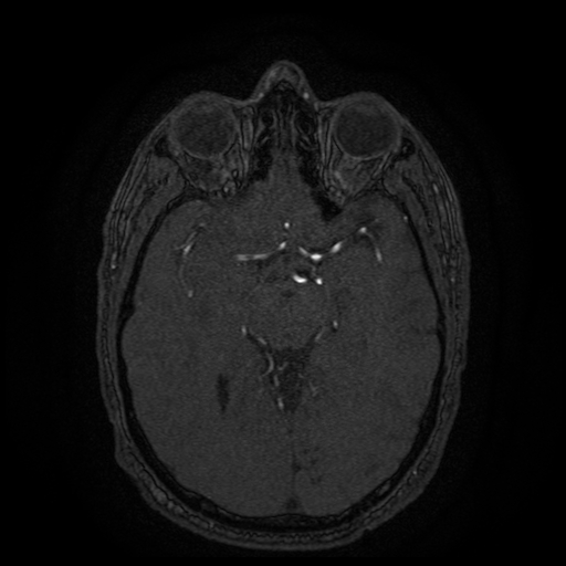 Carotid arterial dissection with acute cerebral infarction (Radiopaedia 26636-26784 MRA 92).jpg