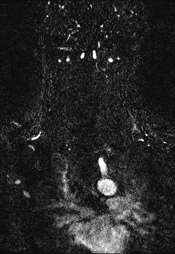 Carotid artery dissection (Radiopaedia 28441-28689 Coronal MRA 69).jpg